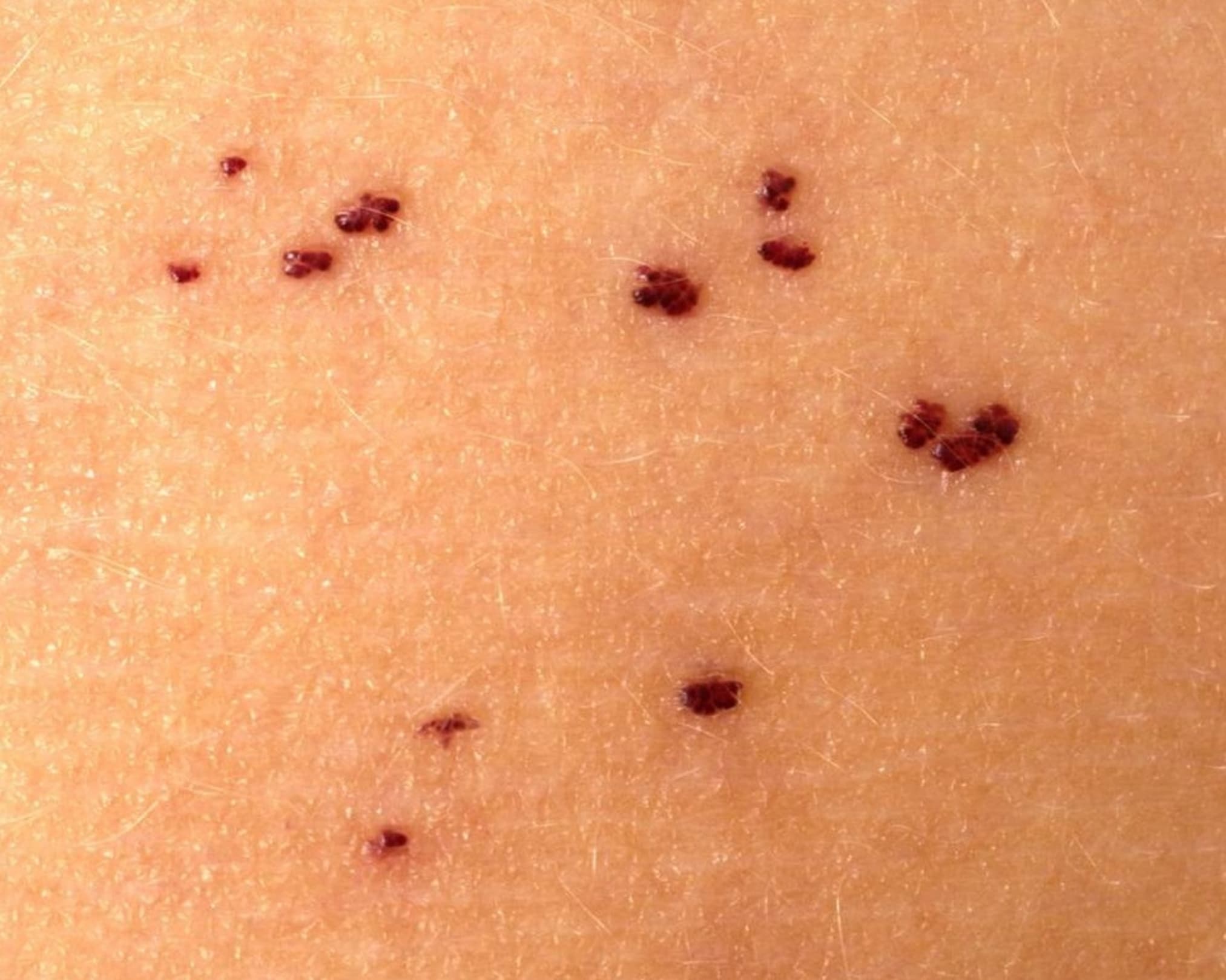 What is a Angiokeratoma