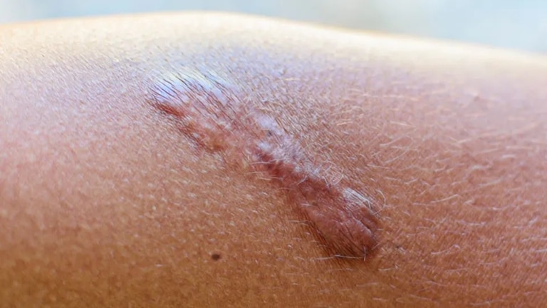 (Post-inflammatory Hyper-/Hypo-pigmentation)