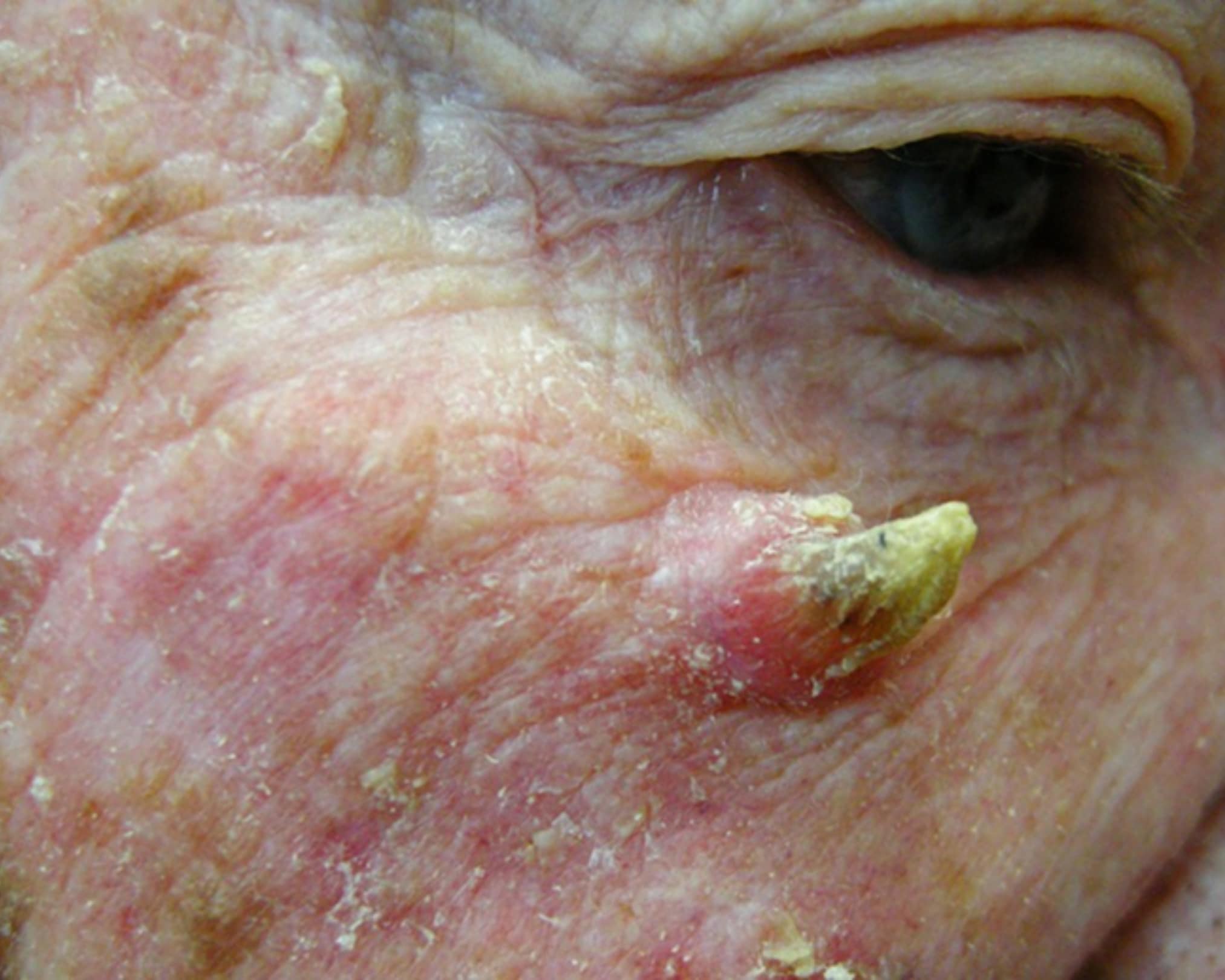 Cutaneous Horn