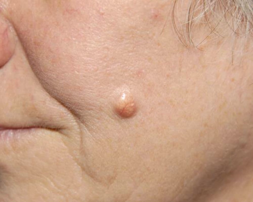 What is an Epidermoid cyst?