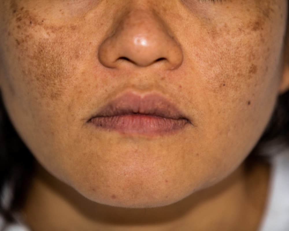Post-Inflammatory Hyperpigmentation (PIH)