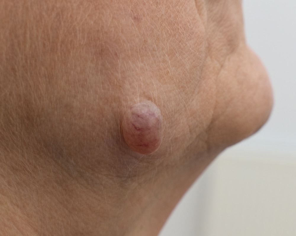 Where on the Body Do They Occur?