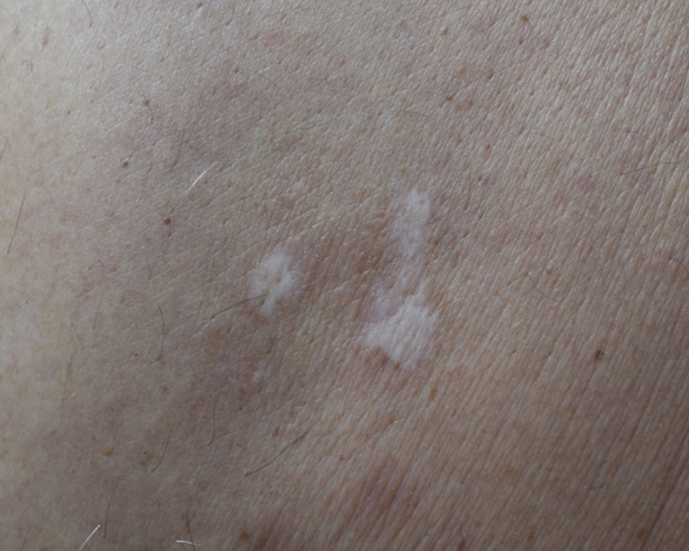 Atrophic / Acne Scars