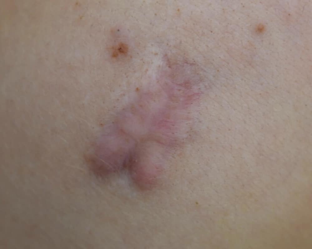 Contracture Scars