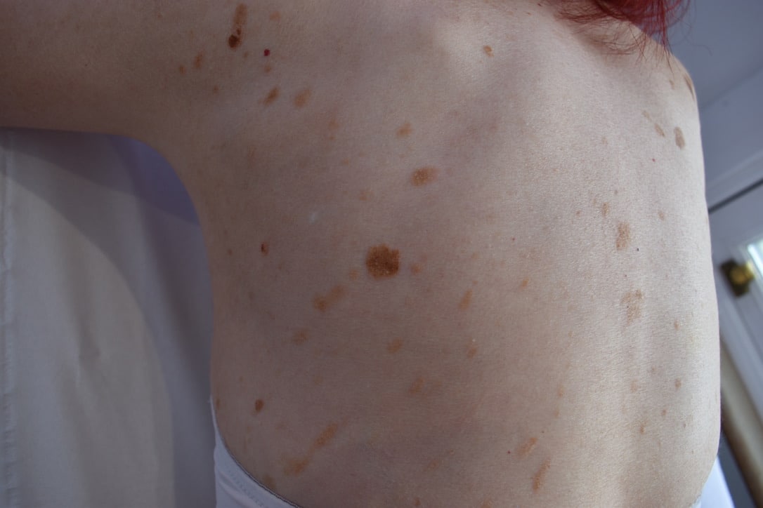 Can seborrhoeic keratosis be prevented?
