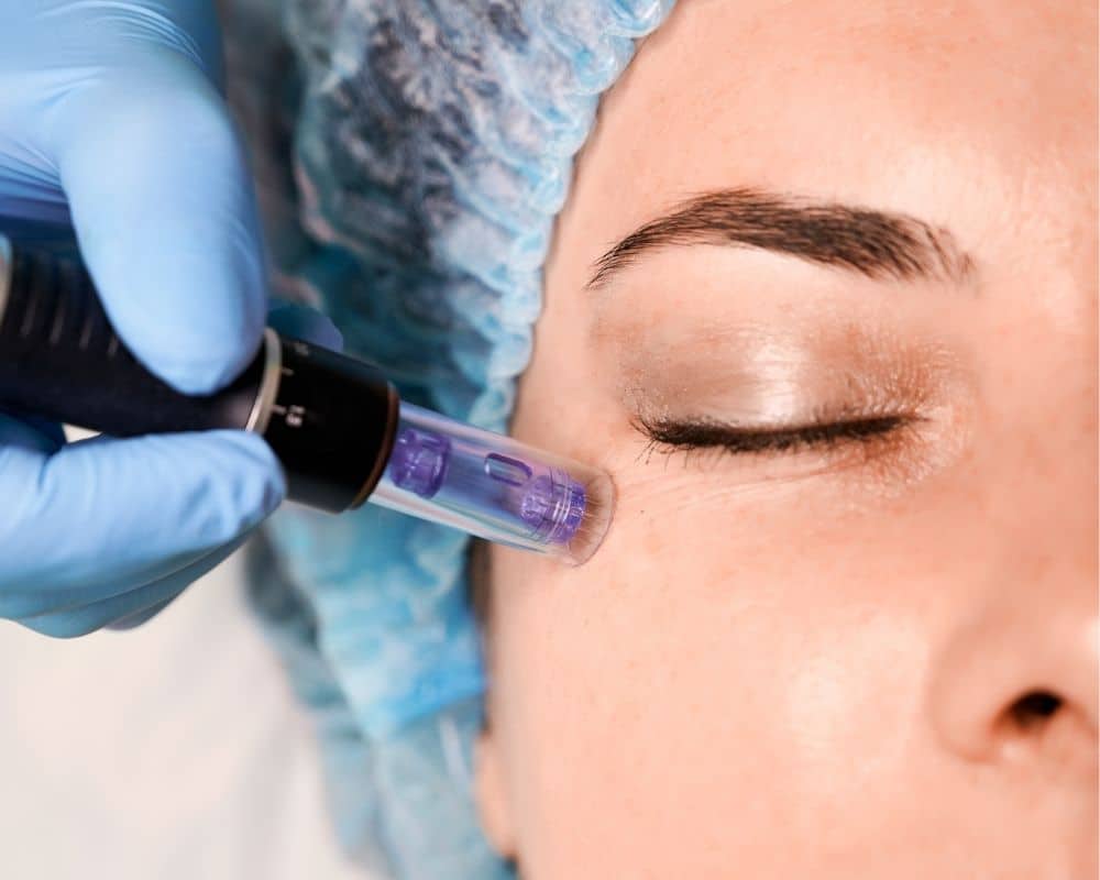 Microneedling