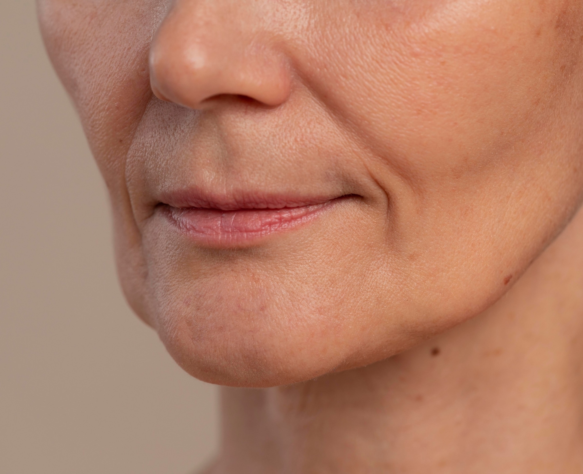 Dermal Filler Treatment