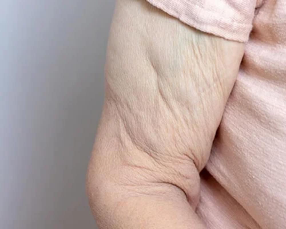 What is Skin Laxity?