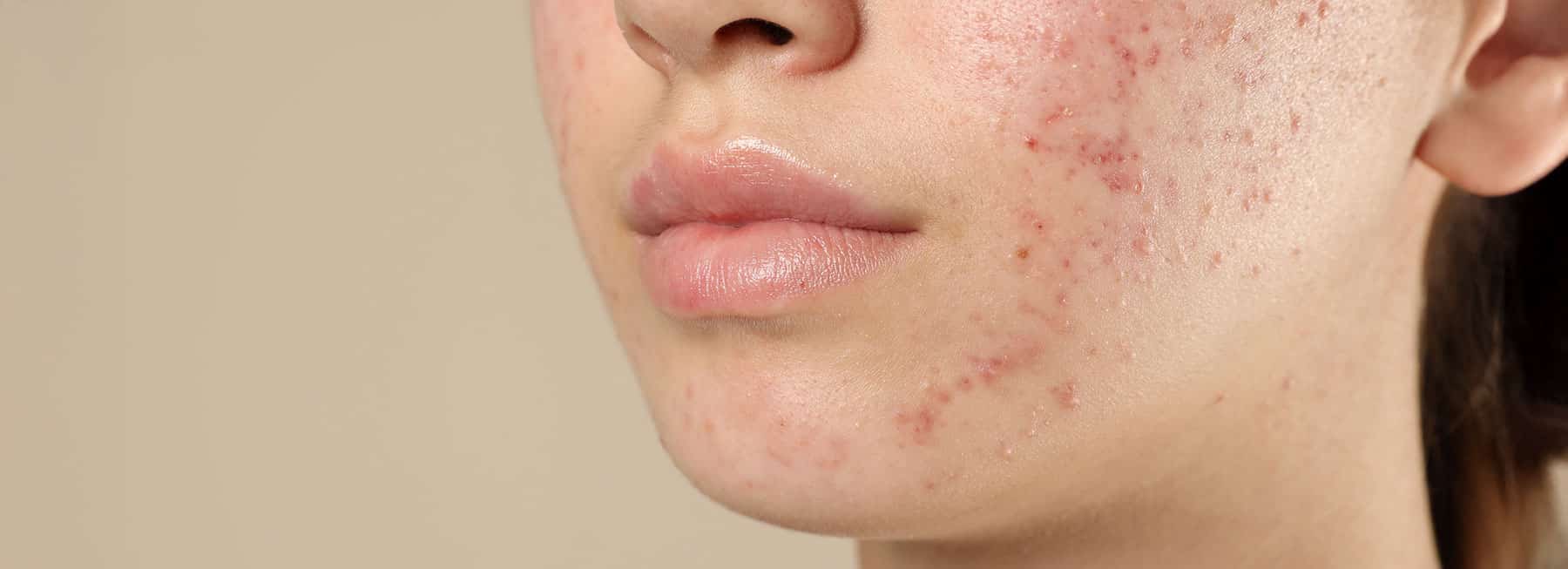 Congested Skin & Acne