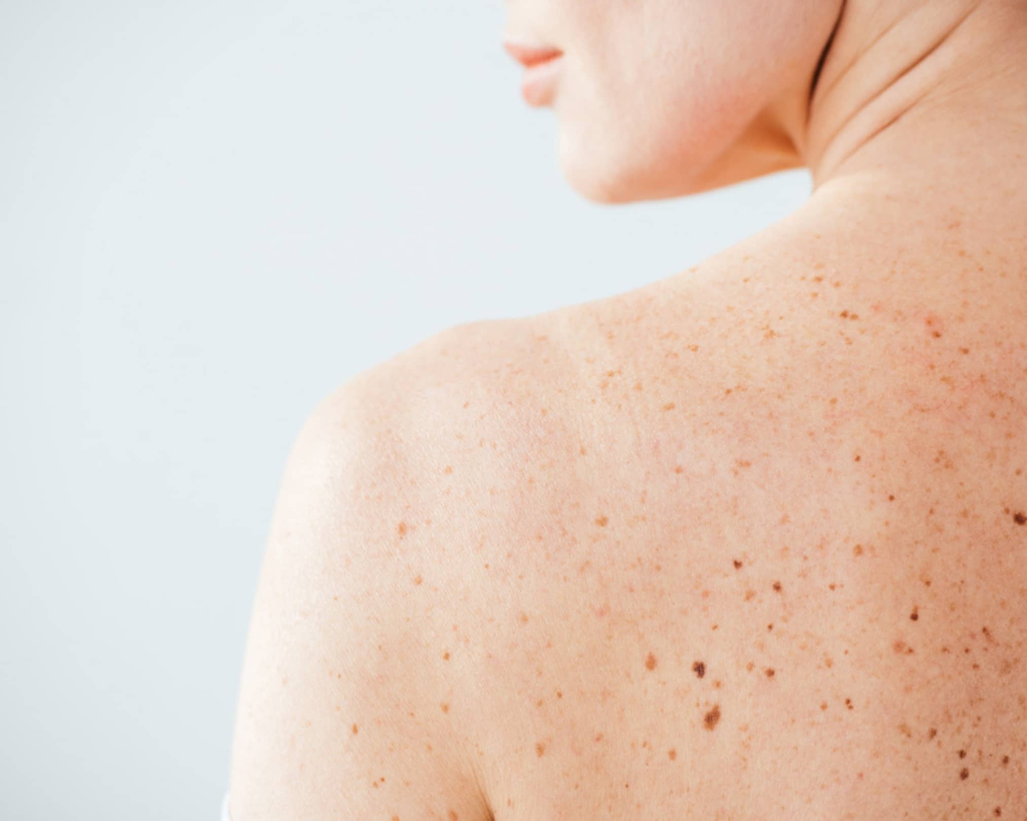 What are skin blemishes?