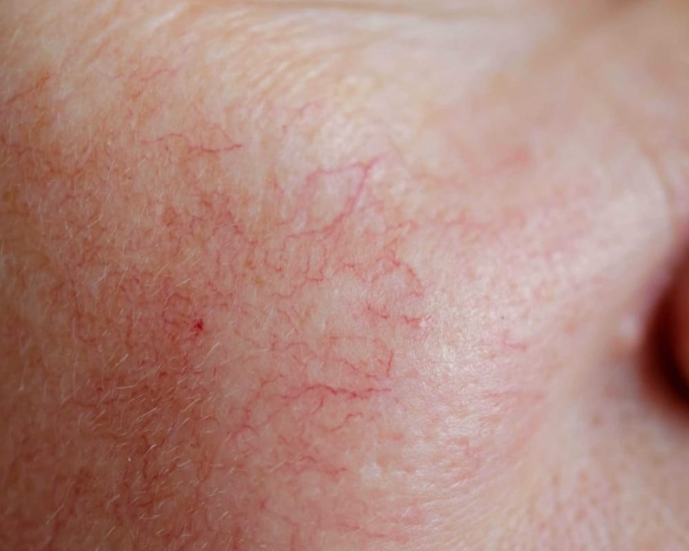 What are thread / spider veins?
