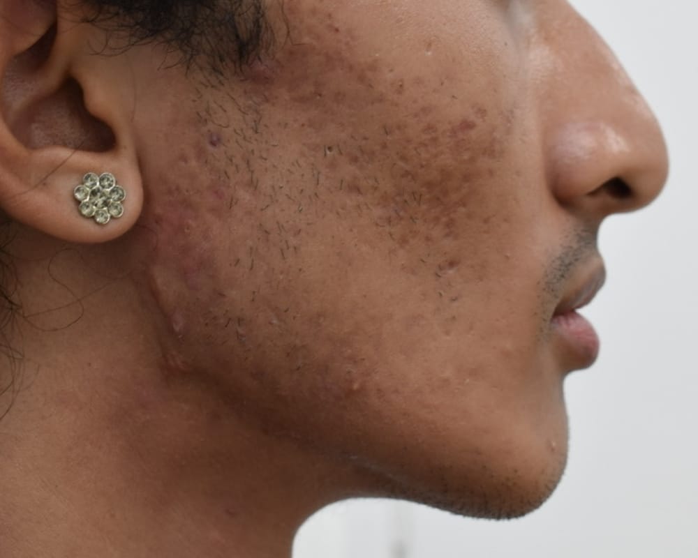 Microneedling & Mesotherapy