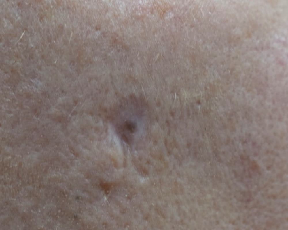 Microneedling & Mesotherapy
